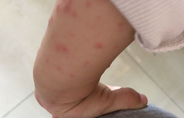 幼儿急疹皮疹特征可分辨