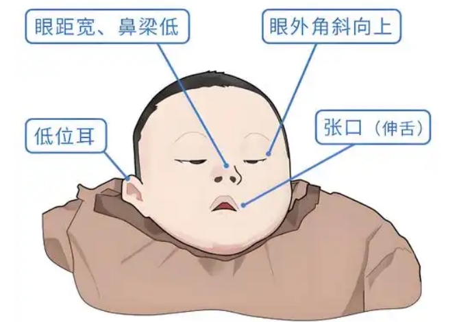 唐氏儿面部特征图片