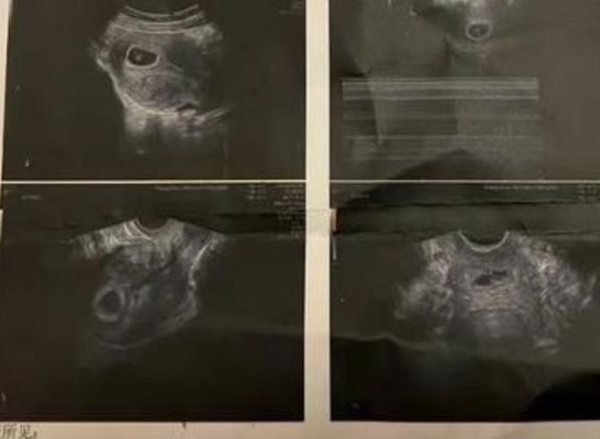 男孩女孩b超单子看胎儿性别图：影像辨男女有据可依，数据猜性别纯属娱乐