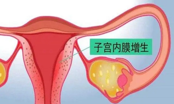 子宫内膜局灶性增生能做试管