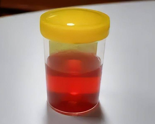 红色尿液可能是泌尿系统引起
