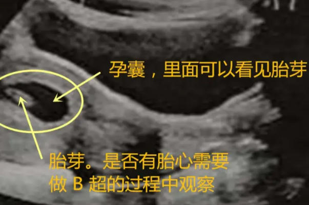 胚胎染色体异常会导致空囊