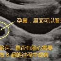 试管移植三十五天无卵黄囊：一文了解这到底意味着什么