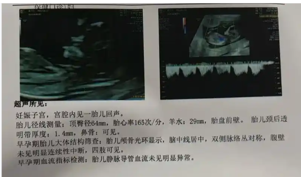 私立医院做NT检查比公立贵