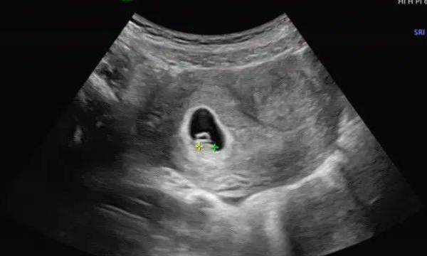 孕囊最安全的位置是宫腔底部