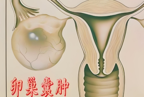 病理性卵巢囊肿会影响<a href=