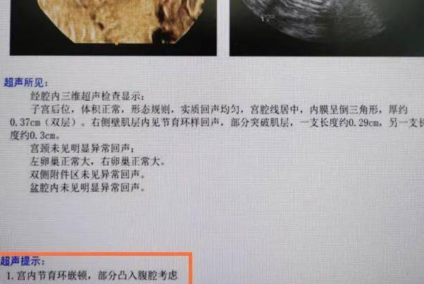 女性确诊为宫外孕后b超上的子宫偏大