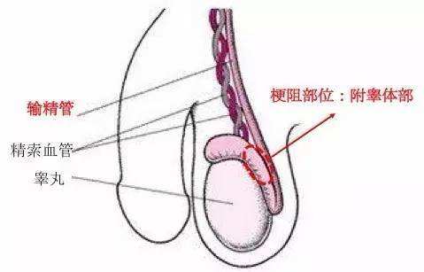 梗阻性无精子症.jpg