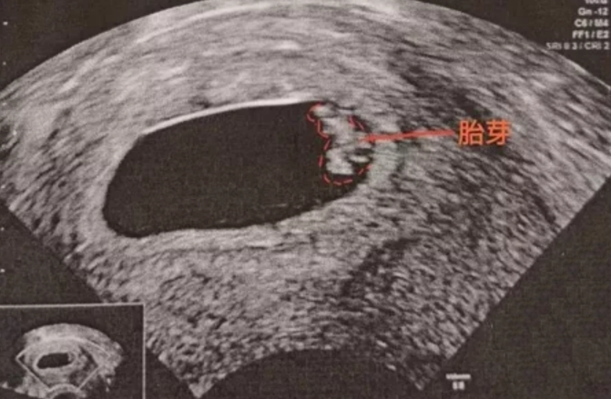 怀孕大哭一场第二天没胎心了