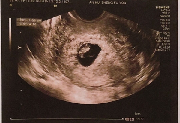 孕囊形状判断胎儿性别的准确率不高