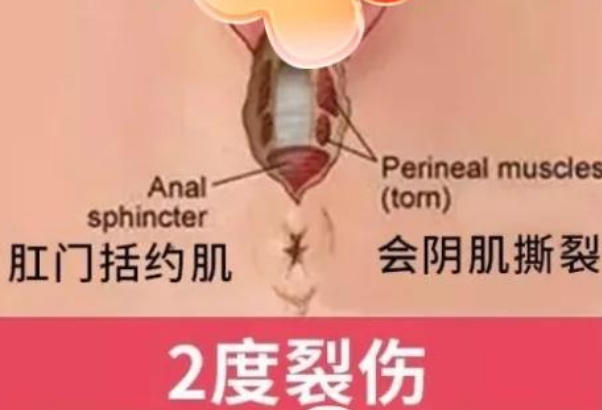 二度会阴裂伤