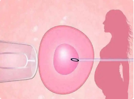 pgs筛查筛查可提高胚胎质量