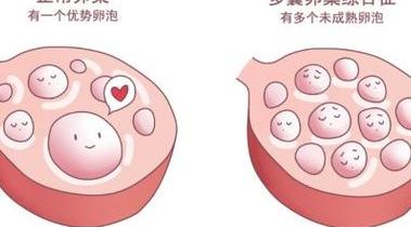 多囊适不适合做试管？卵母细胞采集18颗只配成2枚胚胎，我才真正懂了