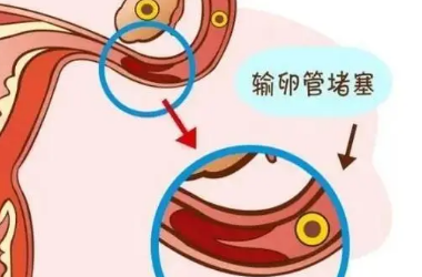 单侧输卵管堵塞的怀孕方法