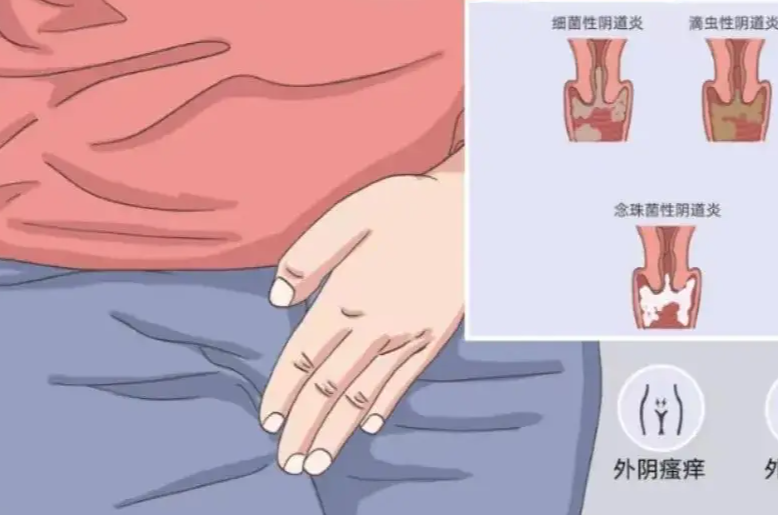 单纯依靠冲洗三天不能治愈阴道炎