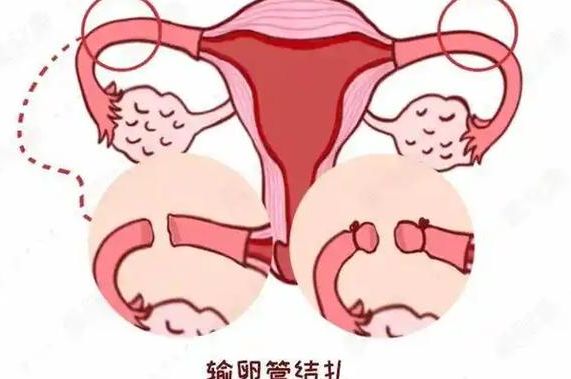 没输卵管对身体的危害：切除PK结扎，别混为一谈