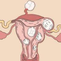 子宫腺肌症打1300元针报销吗?一文教你科学应对