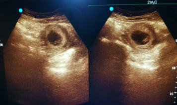 孕囊和蜕膜完整图片，试管也会有蜕膜吗？