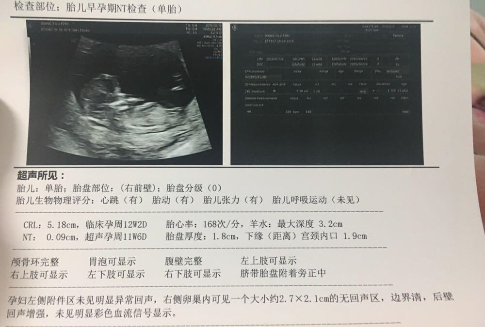 多囊,宫角妊娠.超强好孕迎来小宝宝!