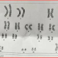 18染色体看男女准确率，胎儿性别只看第23对染色体