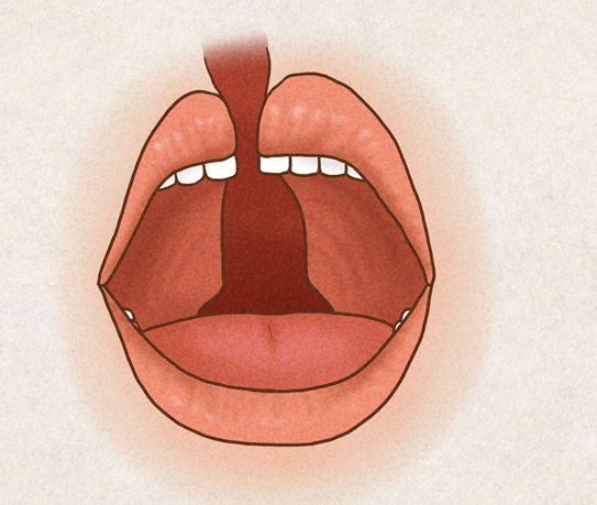 有唇腭裂基因能做试管生育