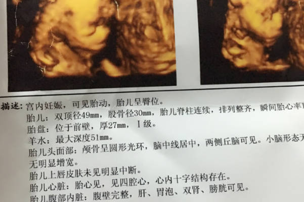 高龄女性如何通过四维彩超看怀的是男宝或是女宝呢？