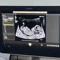 哪种女性nt不容易通过，高龄孕妇、遗传因素等人群风险大