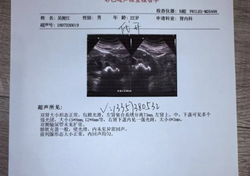 双肾盂分离与生男生女无关