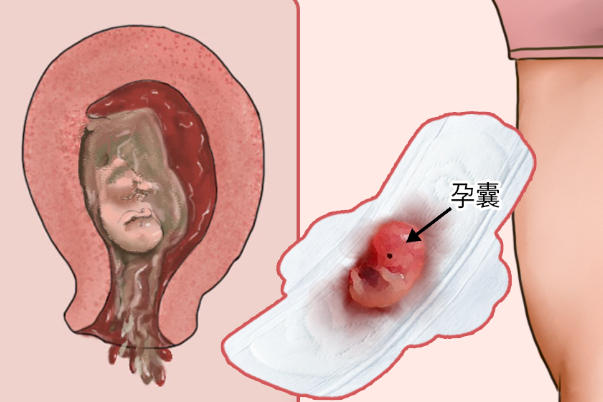 流产后胚胎组织不能干燥保存