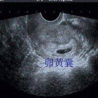 试管第35天有卵黄囊无胎芽胎心?卵黄囊大小也有关系?