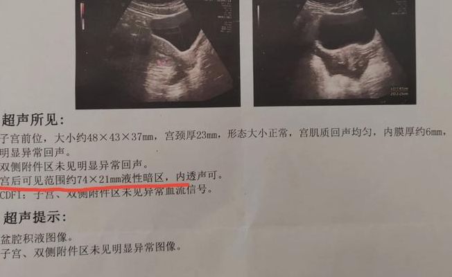 试管婴儿宫外孕可能性大吗？我来说点大实话