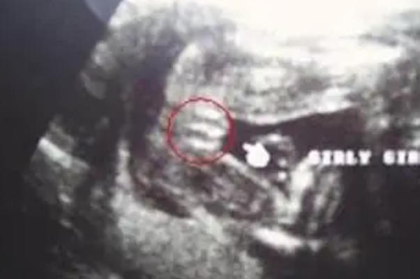 B超上三条线一般说是女孩