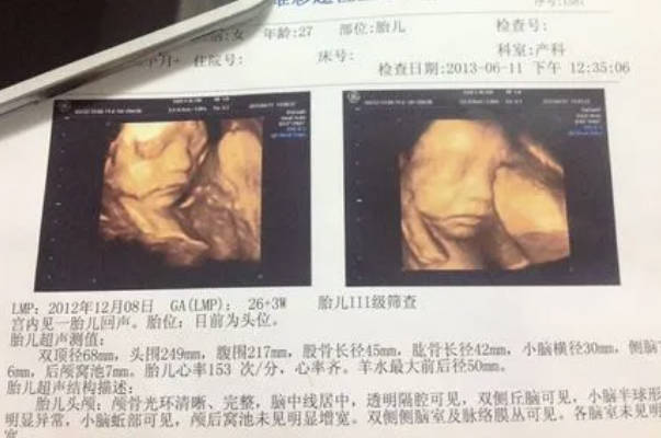 如何3秒钟内从彩超单子上看出宝宝是男还是女呢？