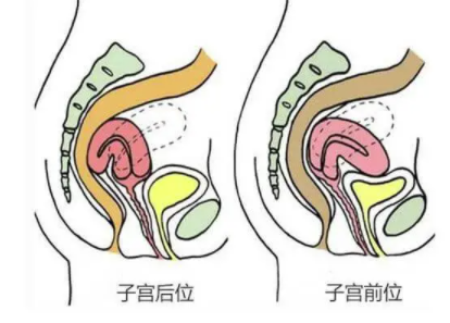 子宫偏位是怎么造成的1.png