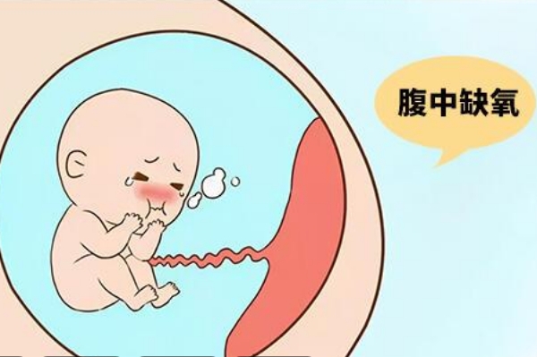 脐带缠绕会导致新生儿缺氧