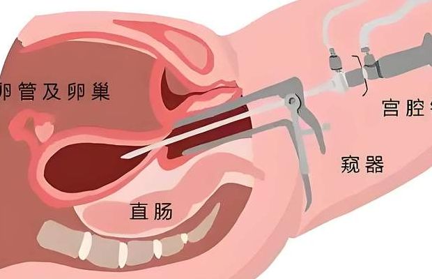 做试管的过程中做宫腔镜手术后还可以自怀孕吗？关键看这三点