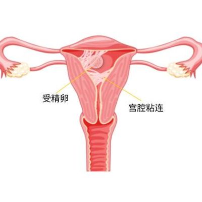 宫腔粘连能做试管婴儿吗？别怕，我35岁刚成功