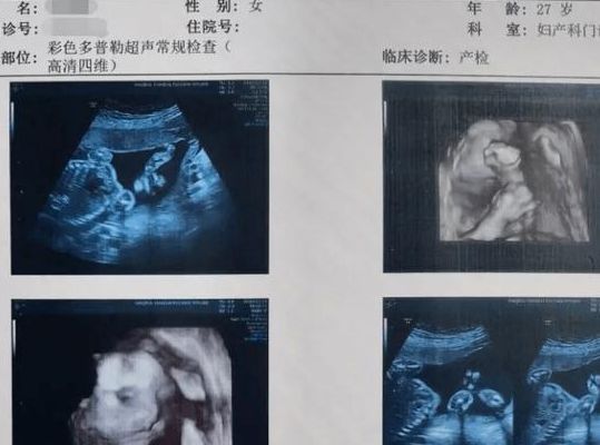 彩超怎么算胎儿多少斤？报告单上这几个数自己就能估