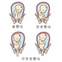 孕妇臀位是怎么引起的?小宝宝屁股朝下不肯转的原因
