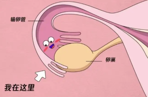输卵管伞端粘连会怀孕吗，还能不能自然受孕