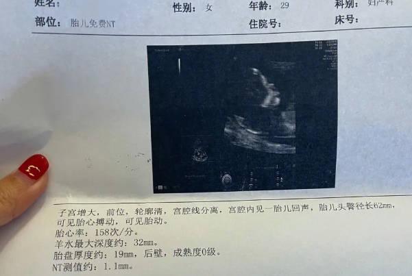 三甲医院做nt花1800元是正常的