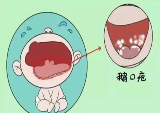 鹅口疮与奶垢