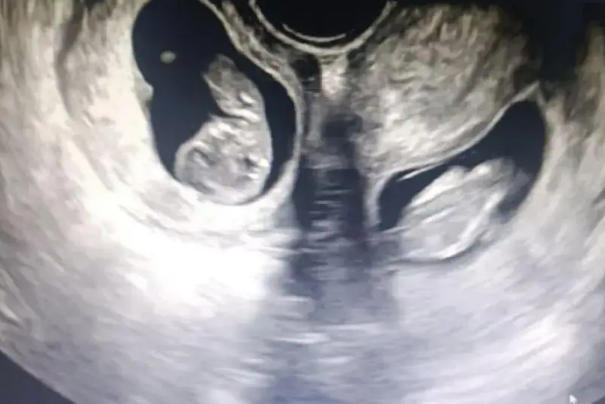 双胞胎B超费用并没有规定固定价格