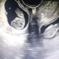 国家b超双胞胎收费标准，具体价格受医疗机构等影响