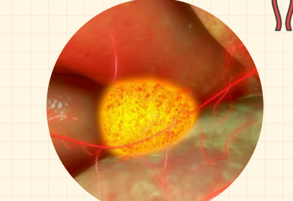 内分泌会影响卵泡发育