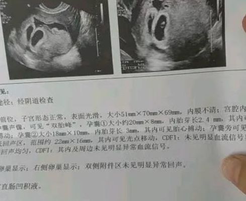 2026年试管婴儿一胎双胎成功率对比解读，单胚为何成主流