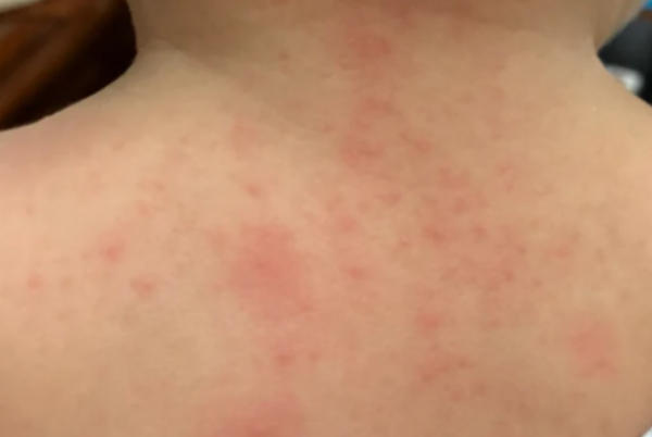 过敏和痱子在成因上有差异