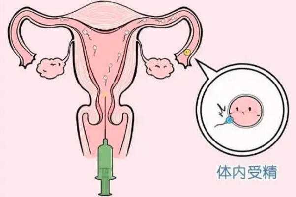 人工授精适合弱精患者