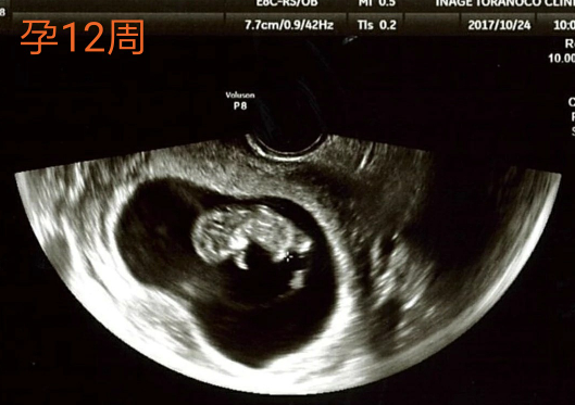孕12周的胎儿大小