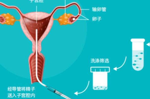 去俄罗斯试管价格是多少？过来人帮你梳理6笔开销明细多少钱